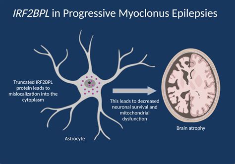 progresif miyoklonik epilepsi